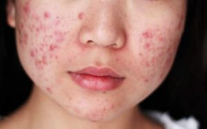 Lo que debes saber sobre el acné